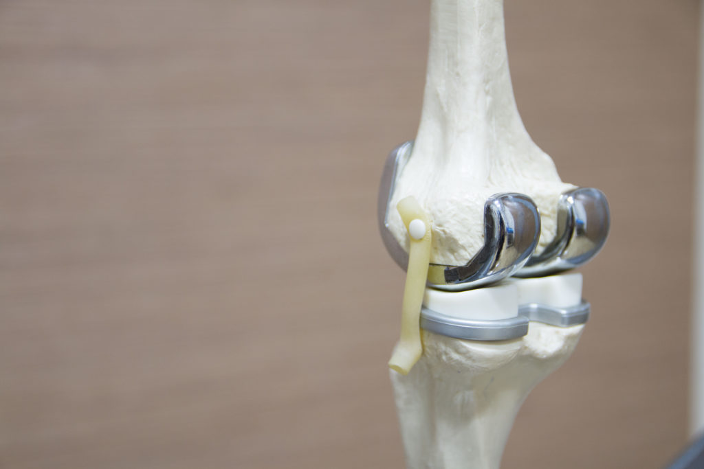 The model of knee joint after a total knee replacement surgery.